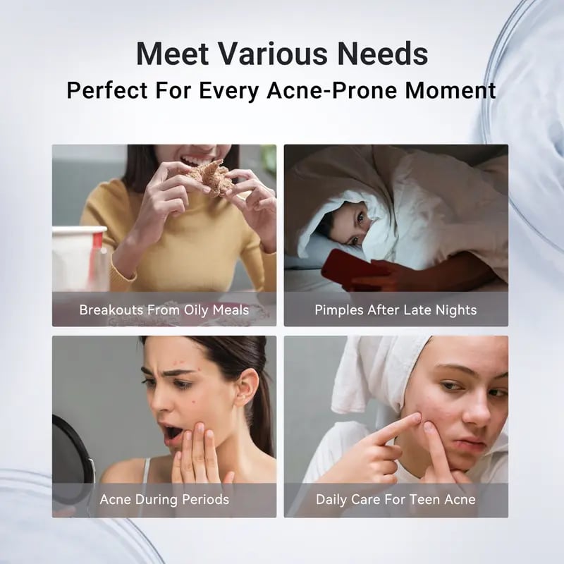 24H Acne & Pimple Treatment Drying Lotion