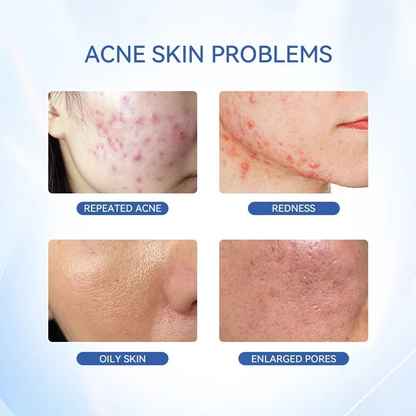 Acne Treatment Drying Lotion | Inflammation Relief, Post-Blemish Care & Oil Control