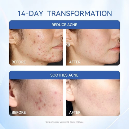 Acne Treatment Drying Lotion | Inflammation Relief, Post-Blemish Care & Oil Control