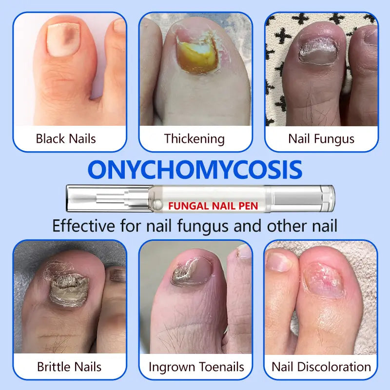 Fungal Nail Repair Pen – Clinically Effective with Allicin & Undecylenic Acid for Healthy Nails!