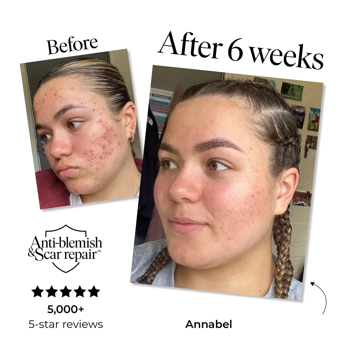 Anti-Blemish & Scar Repair Serum