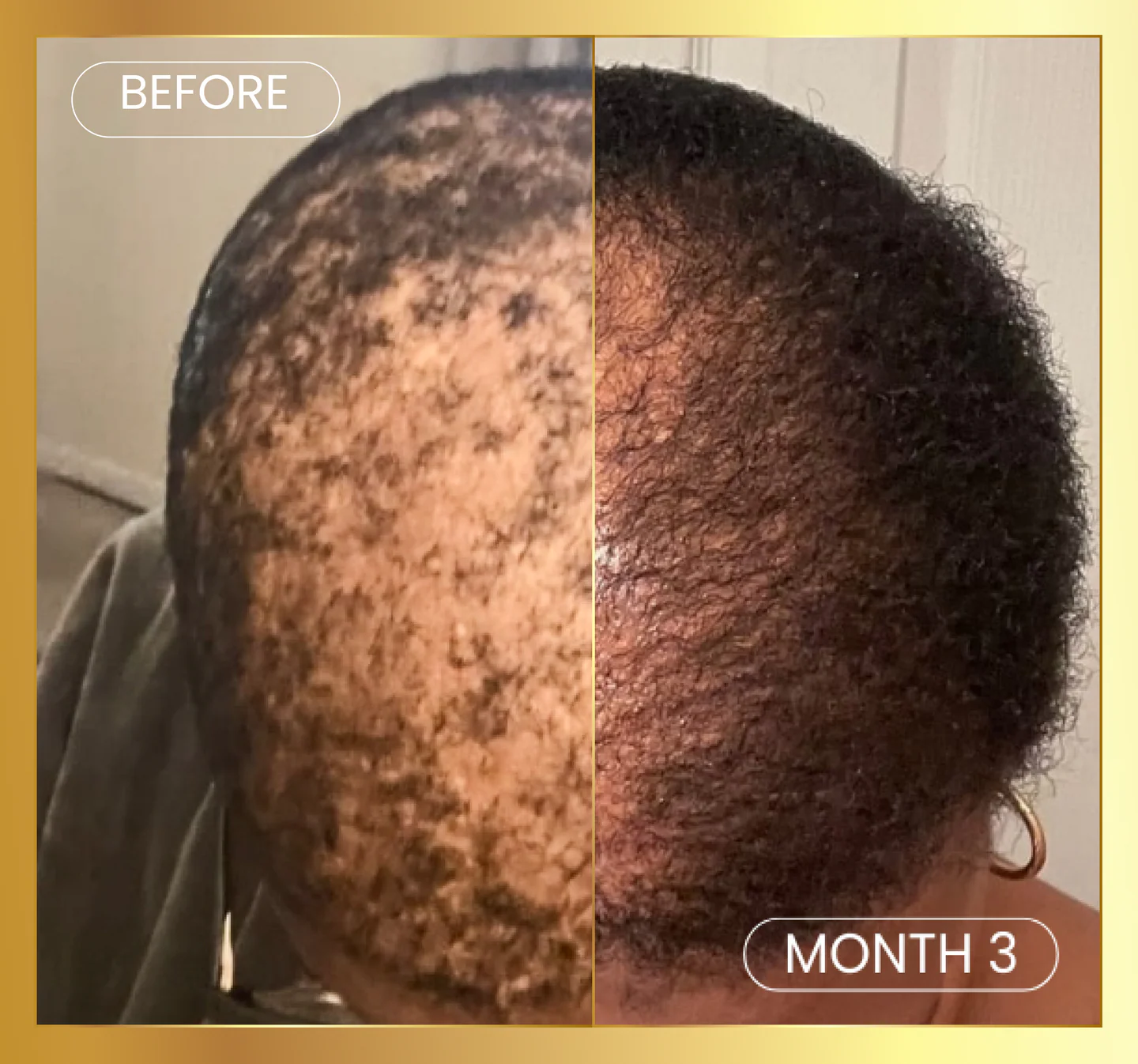 Scalp Stimulator Hair Growth Oil