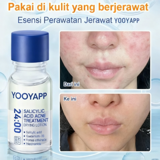 Acne Treatment Drying Lotion | Inflammation Relief, Post-Blemish Care & Oil Control